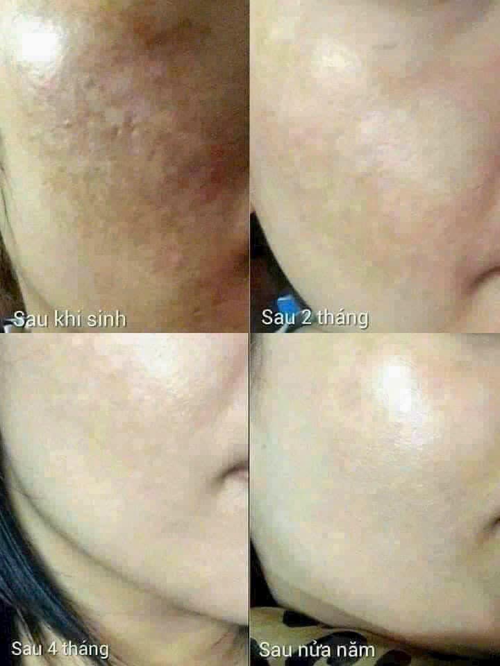 Set Cao Đặc Trị Nám Sạm Tàn Nhang Cao Cấp nhà Whoo 3